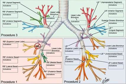 BRONCHIAL THERMOPLASTY 5.jpg