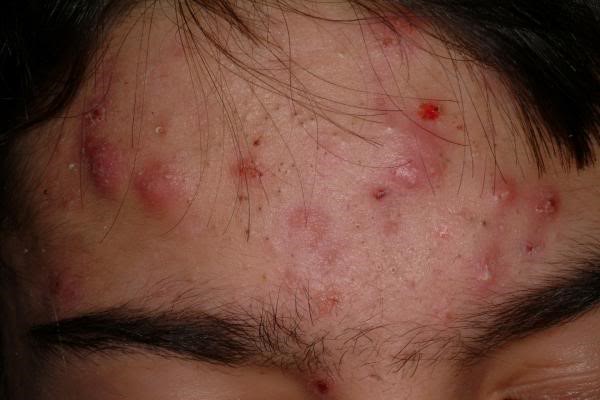 Acne scars