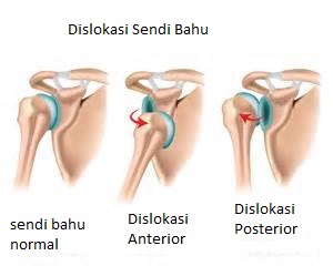 Dislokasi sendi bahu -f