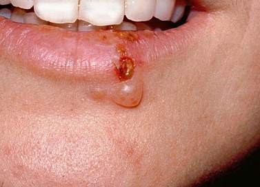 Herpes Labialis In Adult