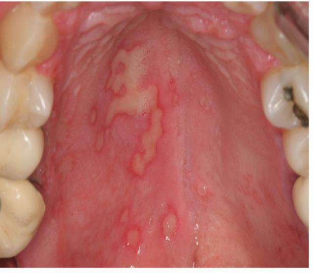 herpes-simplex-infection-nrn