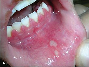 Herpetic Gingivostomatitis