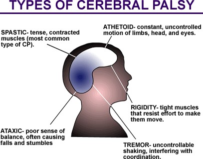 PALSI CEREBRAL