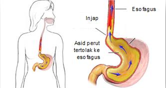 Pedih ulu hati