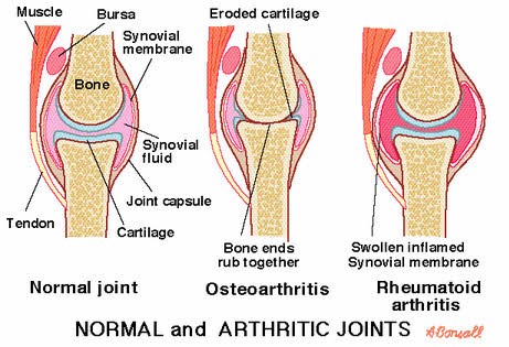 rheumatoid-1