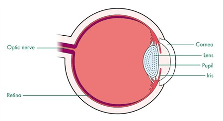 Retinoblastoma_1