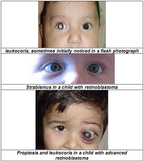 Retinoblastoma_2