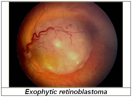 Retinoblastoma_3