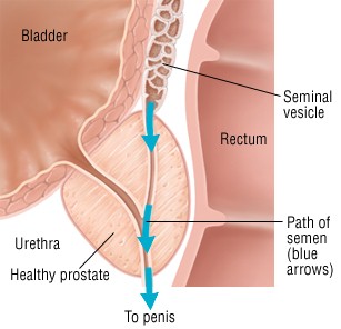 Retrograde ejaculation1