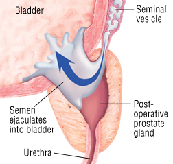 Retrograde ejaculation2