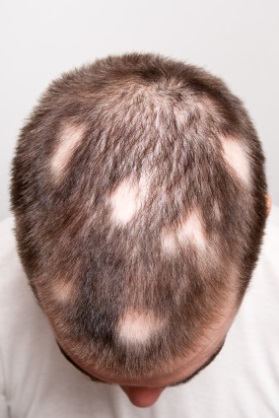 alopecia1