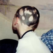 alopecia2