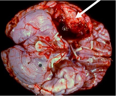 encephalitis_1