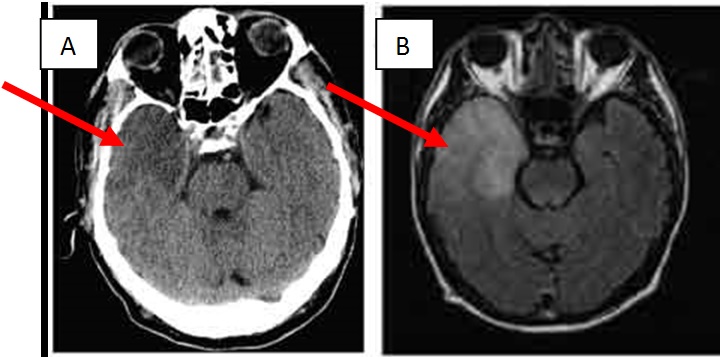 encephalitis_2