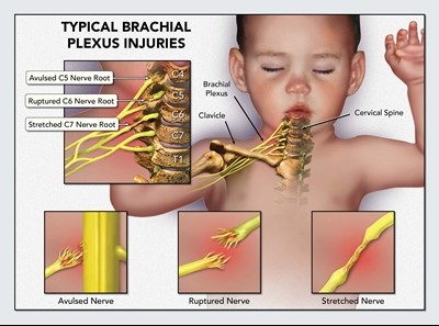 erbpalsy