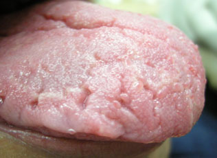 Fissured Tongue