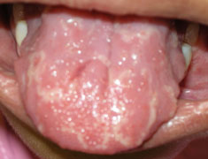 Geographic Tongue