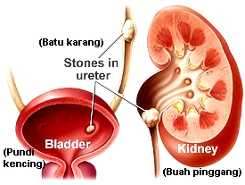 kidney-stone