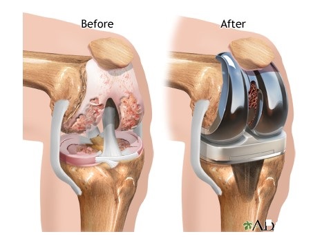 knee-replacement1