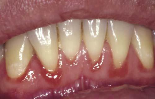 linear-gingiva-erythema