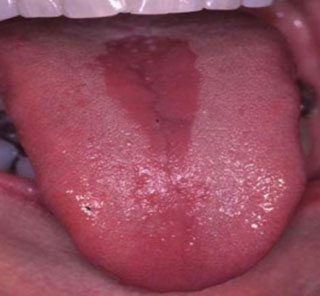 Median Rhomboid Glossitis