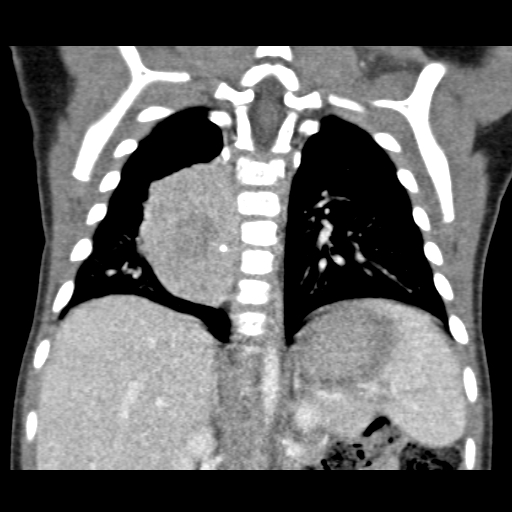 neuroblastoma3