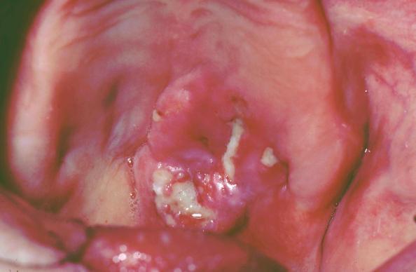 non-hodgkin-lymphoma