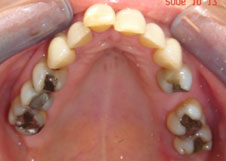 Orthodontics Treatment to realign the teeth with orthodontic braces