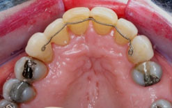 Orthodontics Treatment to realign the teeth with orthodontic braces