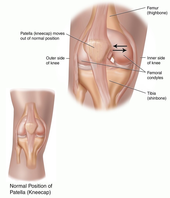 patella1