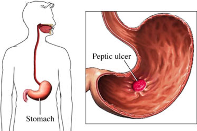 peptic_ulcer