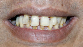 Restorative treatment with crown, bridge and implant