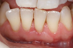 Periodontal Surgery With Soft Tissue Grafting