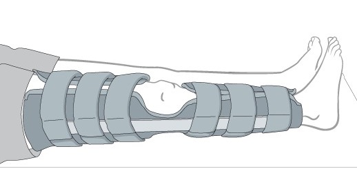 splinting