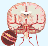 https://myhealth23.primuscore.com/myhealth/eng/$public/story_images/adult/stroke1.jpg