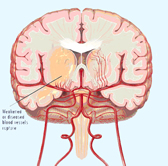 https://myhealth23.primuscore.com/myhealth/eng/$public/story_images/adult/stroke2.jpg