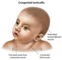 torticollis(bi)